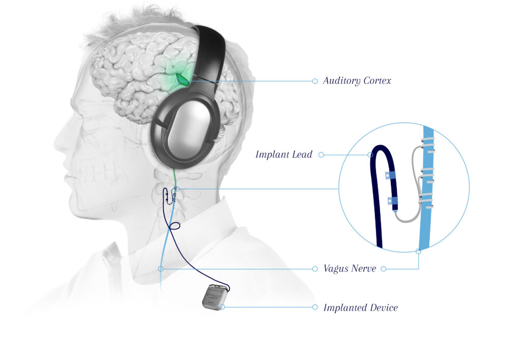 Tinnitus-VNS-graphic_v2